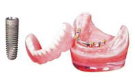 Removable Implant Overdenture