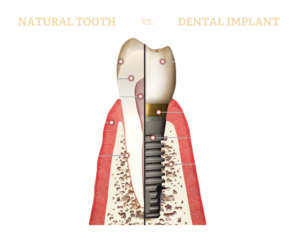 Natural Tooth vs. Dental Implant